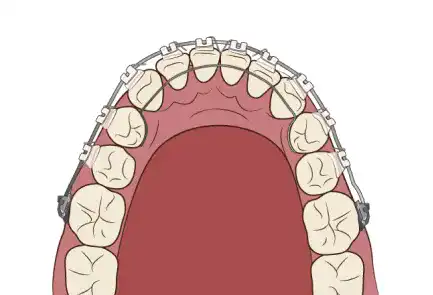 ワイヤー矯正